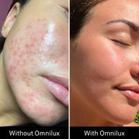 Split image showing facial skin with acne before Omnilux Clear and clearer skin after Omnilux Clear treatment.