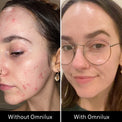 Split image of a woman's face before and after Omnilux Clear—left with acne, right clear, smooth, wearing glasses.