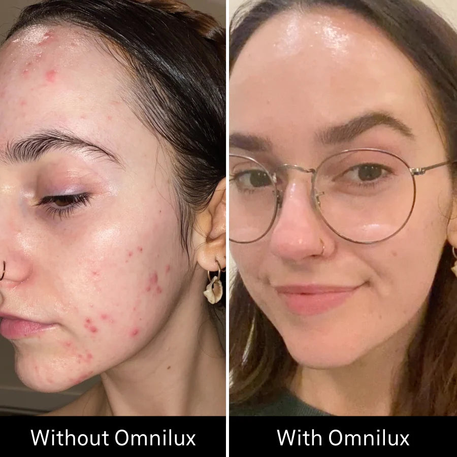 Split image of a woman's face before and after Omnilux Clear—left with acne, right clear, smooth, wearing glasses.
