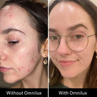 Split image of a woman's face before and after Omnilux Clear—left with acne, right clear, smooth, wearing glasses.