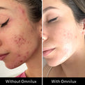 Side-by-side comparison of acne-prone skin before and after Omnilux Clear shows visible improvement and a clearer complexion.