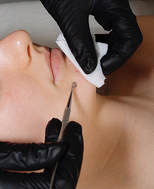 A person’s face being treated with a blackhead remover tool by someone wearing black gloves.